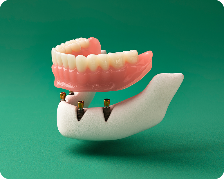 3D dental model rendering of an implant-supported denture demonstrating how it securely attaches to the dental implants.