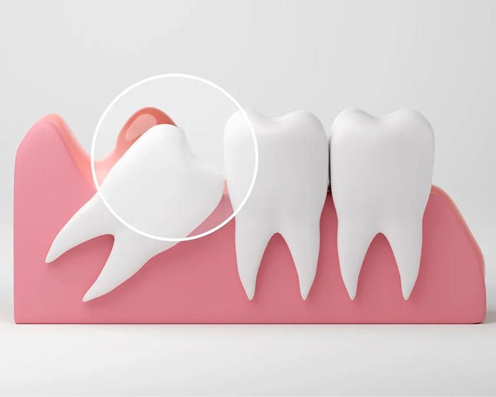 Illustration of impacted wisdom tooth highlighted for removal next to healthy teeth.