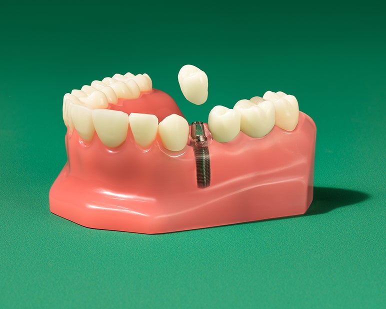 WB AD DentalImplantsCostLongformTypesmulticardSingletoothimplants 20260123