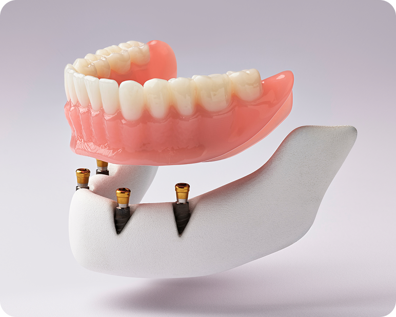 Implant-supported lower denture model positioned above dental implants.