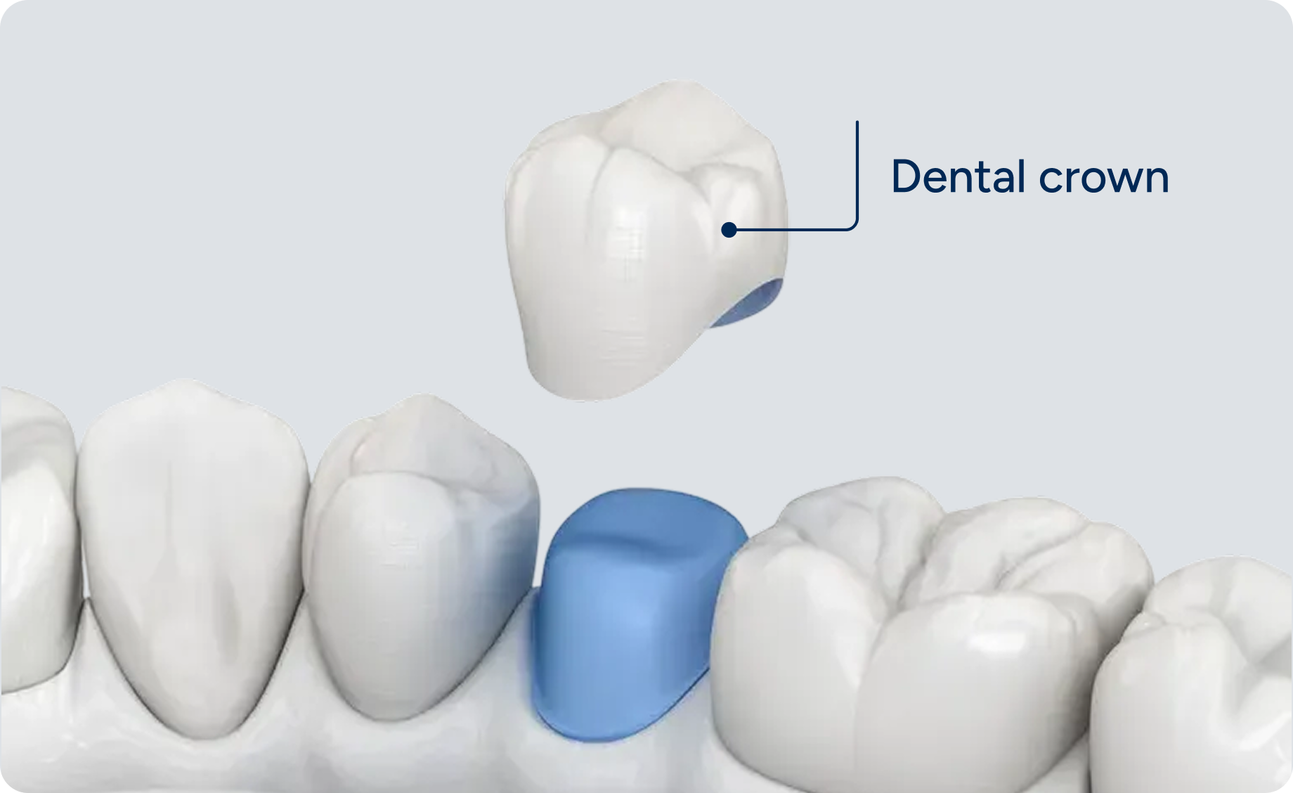 3D illustration showing a dental crown positioned above a prepared tooth, demonstrating crown placement in a dental restoration procedure.
