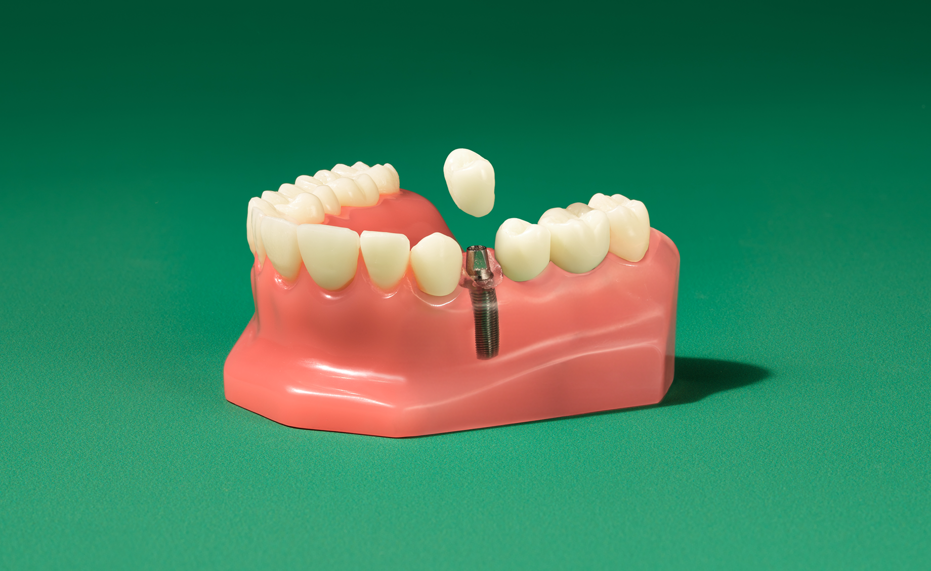 Alt text:
Close-up dental model showing a single tooth implant placed in pink gums.