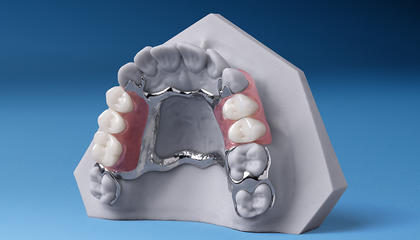Flexilytes Combo partial denture on a dental model, highlighting the metal framework combined with a flexible, gum-colored base.