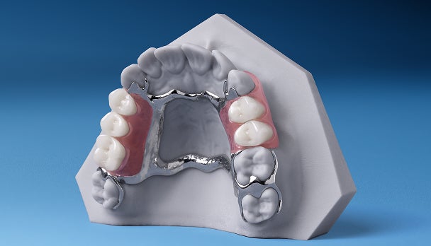 Flexilytes Combo partial denture on a dental model, highlighting the metal framework combined with a flexible, gum-colored base.