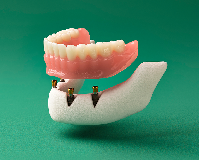Implant-supported denture model