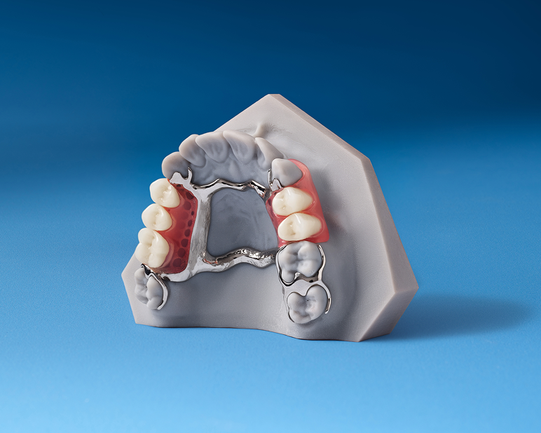 A removable partial denture on a dental model