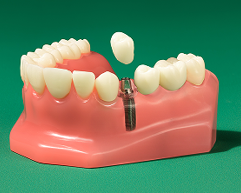 Alt text: Dental model showing an implant crown placed in the gum demonstrating an example of dental implant treatment.