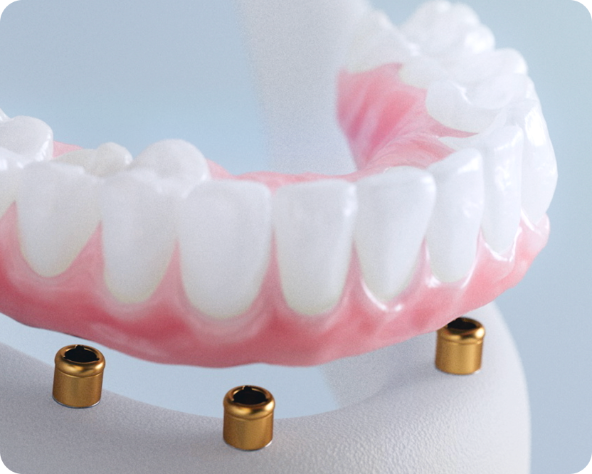 Artificial teeth supported by dental implants