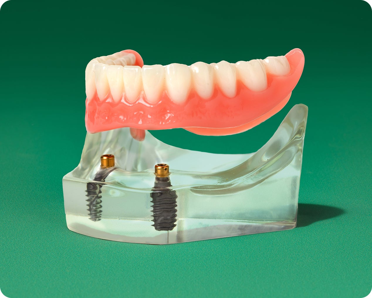 Implant-supported denture model showing a secure denture attached to dental implant.