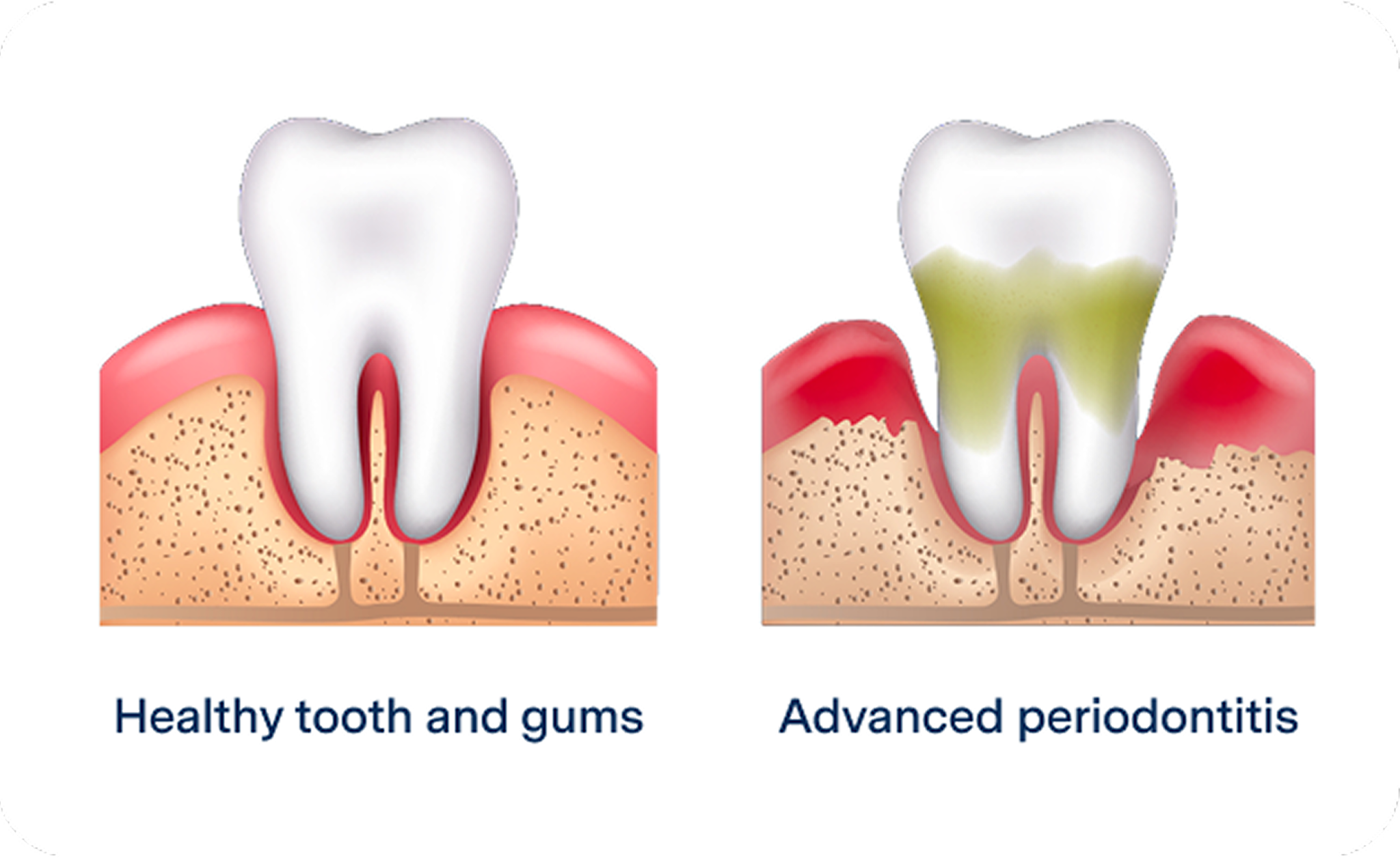Side-by-side diagram comparing a healthy tooth and gums with advanced periodontitis showing gum inflammation and bone loss.