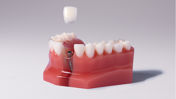 Dental implant model showing post and crown
