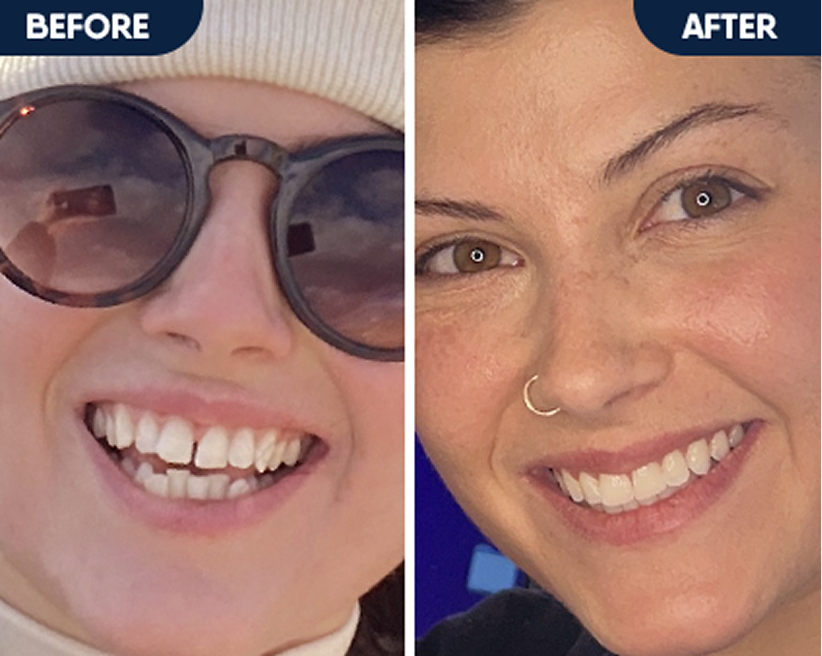 Before and after a smile transformation, closing a front tooth gap