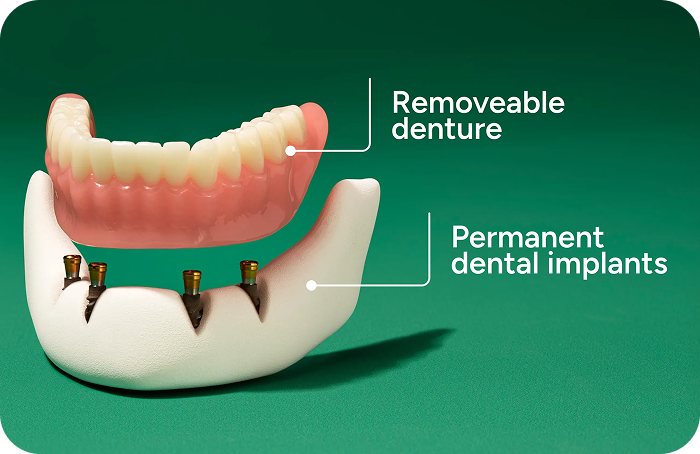 Diagram illustrating the components of an implant-supported denture, showing a removable denture positioned above four permanent dental implants in the lower jaw.