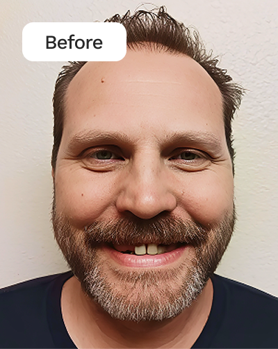 WB AD Full Dentures LF AJ Before 20260129