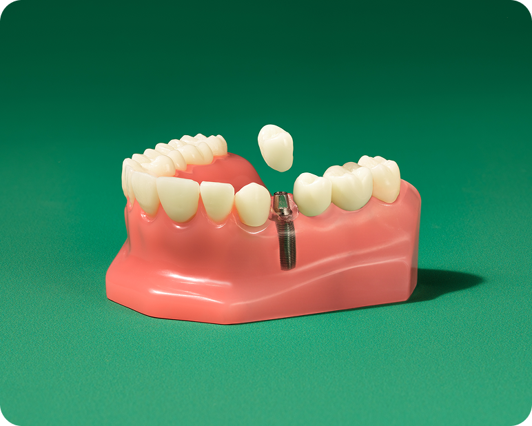 Single tooth dental implant model illustrating a custom crown being placed onto a titanium implant post.