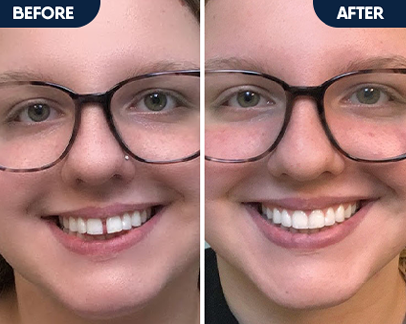 Smile transformation: before and after gap closure