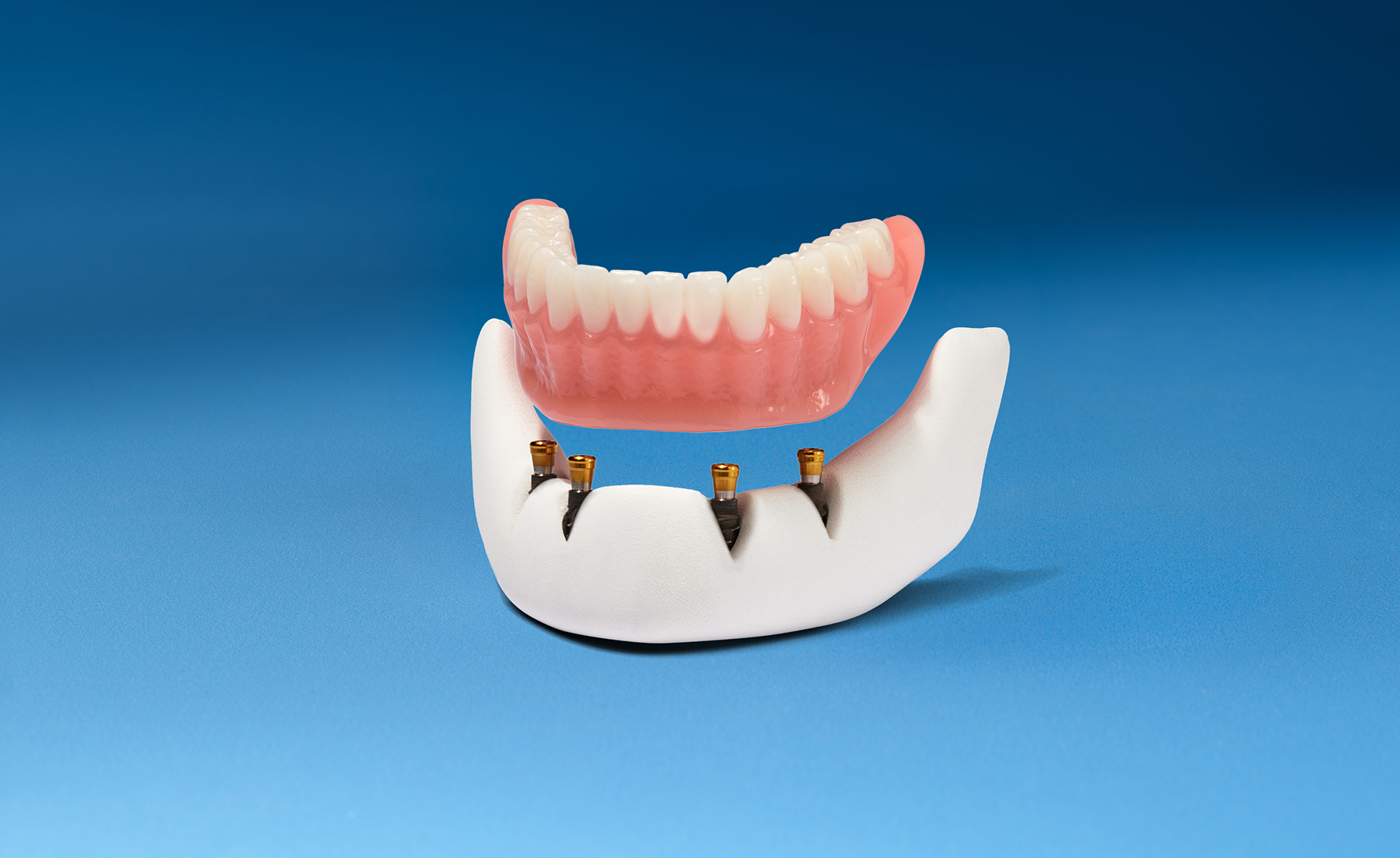 Implant-supported lower denture model positioned above dental implants.