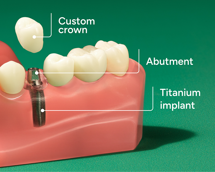 Labeled diagram of a single tooth dental implant showing the crown, abutment, and titanium implant in the jaw.