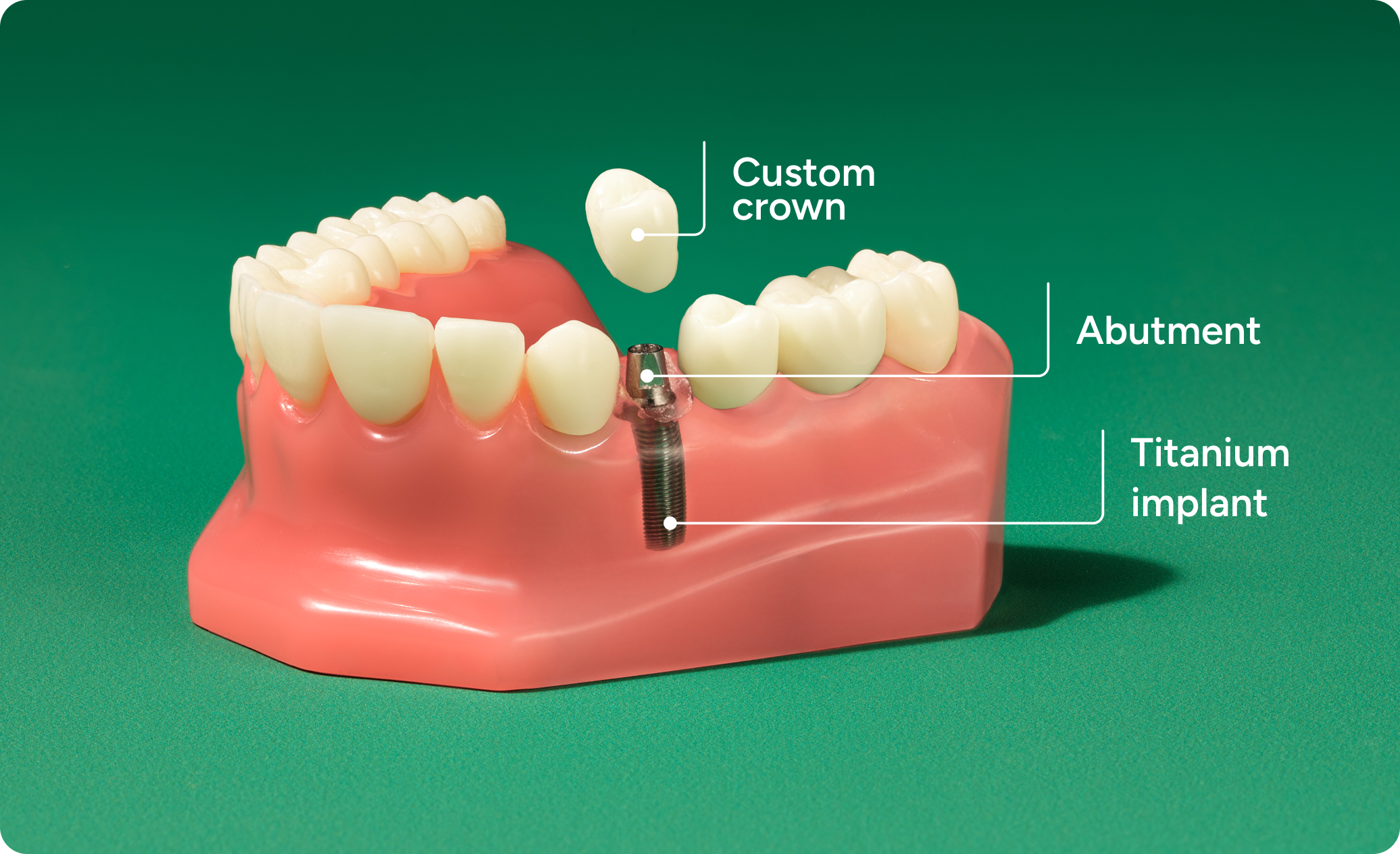 Labeled single tooth implant diagram showing a custom crown, abutment, and titanium implant within the jaw.
