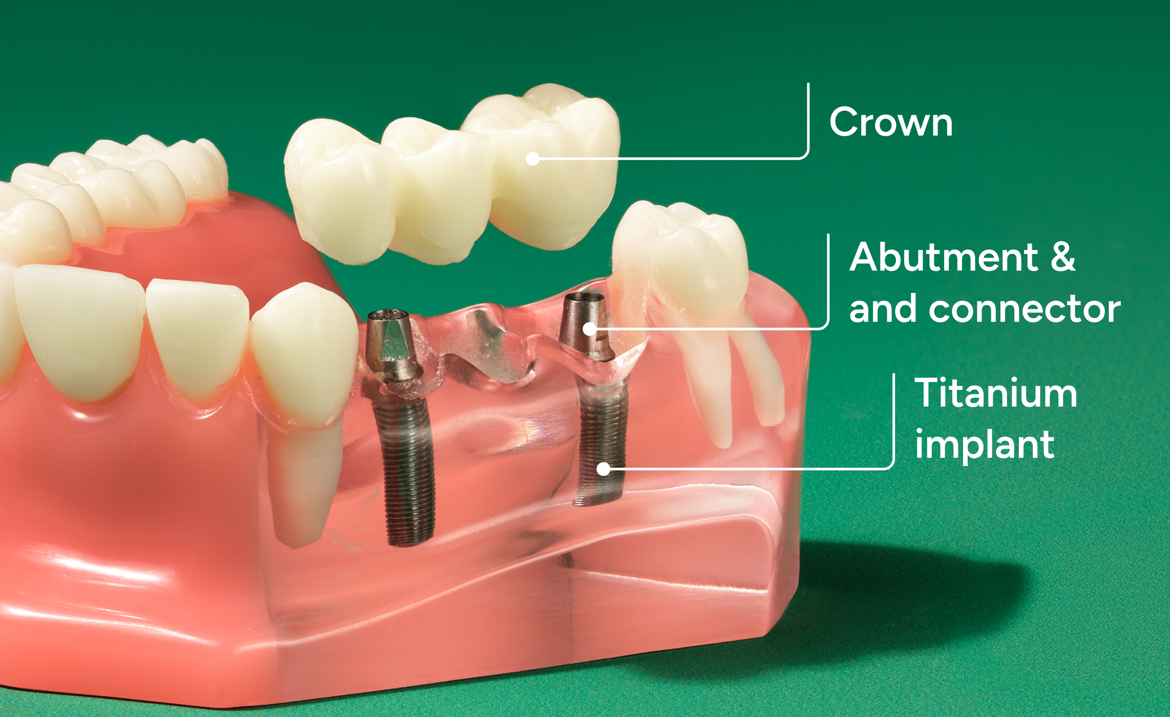 Labeled dental implant bridge model showing the crown, abutment and connector, and titanium implant components in the lower jaw.
