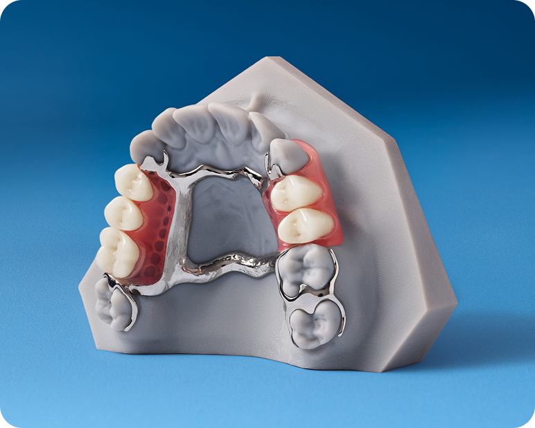 Upper partial denture model with metal framework and pink acrylic base.