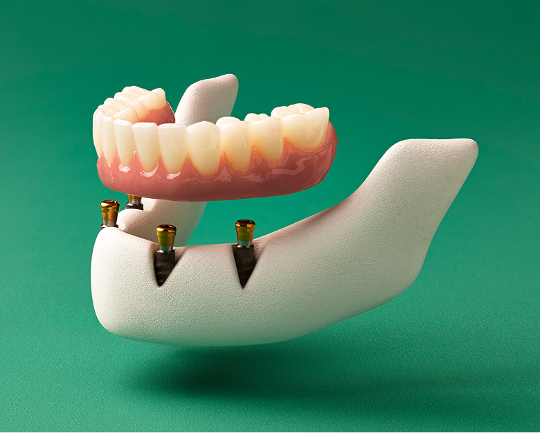 3D illustration of a lower full-arch fixed permanent implant restoration supported by multiple dental implants, shown slightly separated to demonstrate attachment.
