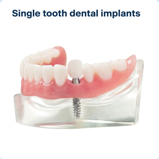 A realistic model of  lower arch, with a single tooth dental implant anchored to the gums through an implant post.