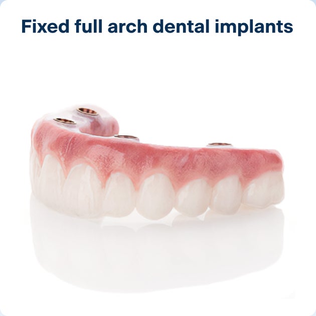 A realistic model of an upper arch dental implant, which will be anchored to the gums with four implant posts.