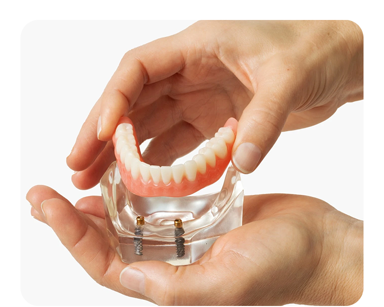 A pair of hands holds a lower denture model above a clear base showing two dental implants, demonstrating how implant-supported dentures attach securely.