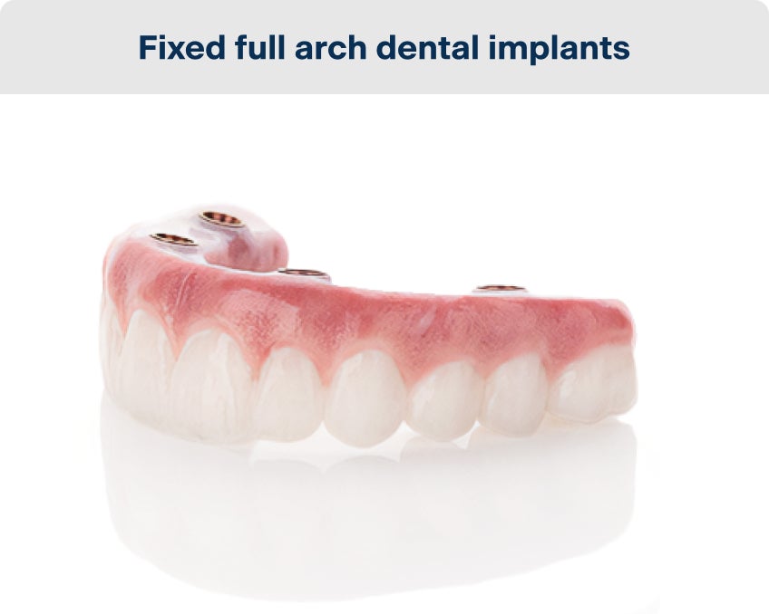 Angled view of a fixed full arch dental implant prosthesis, showing natural-looking teeth and implant connection points.