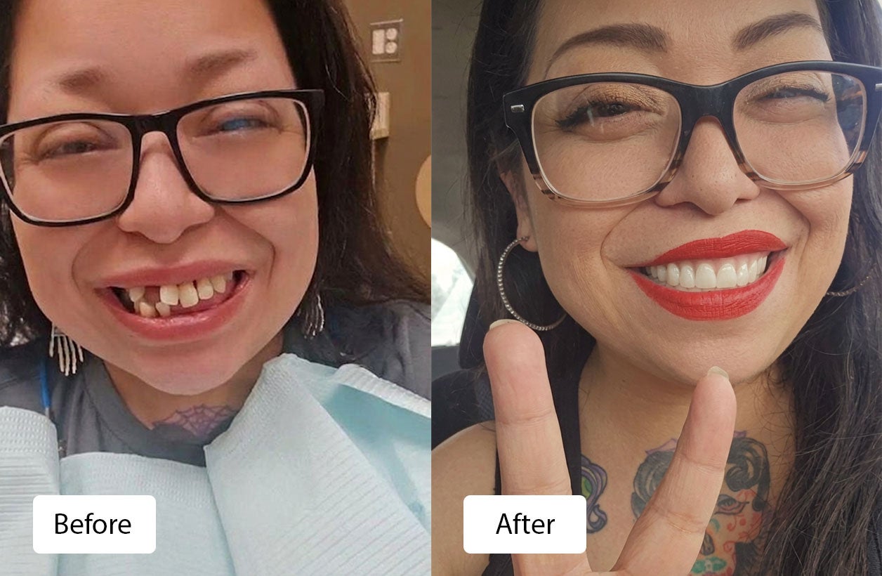 Nichole Garcia before and after implant dentures
