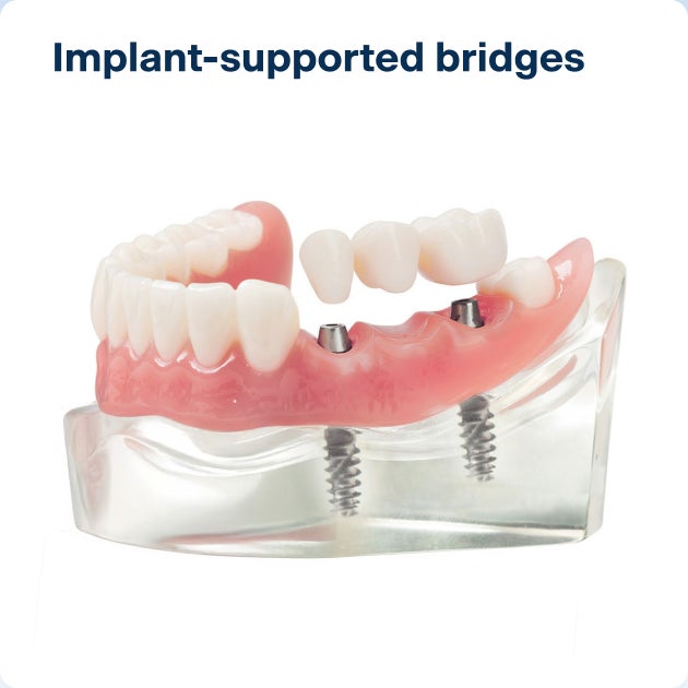 A realistic model of a lower dental arch, with a dental bridge attached to the gums through implants, supporting the middle tooth through implants on the two neighboring teeth.