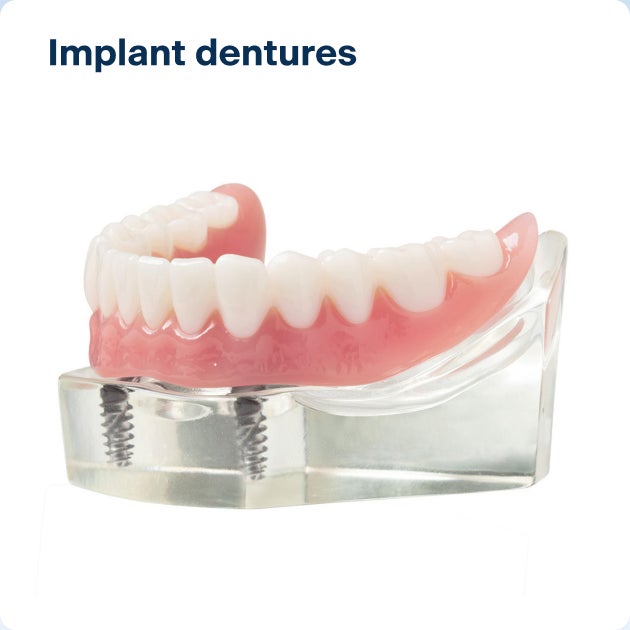 A realistic model of a lower arch implant denture, anchored to the gums through two implant posts.