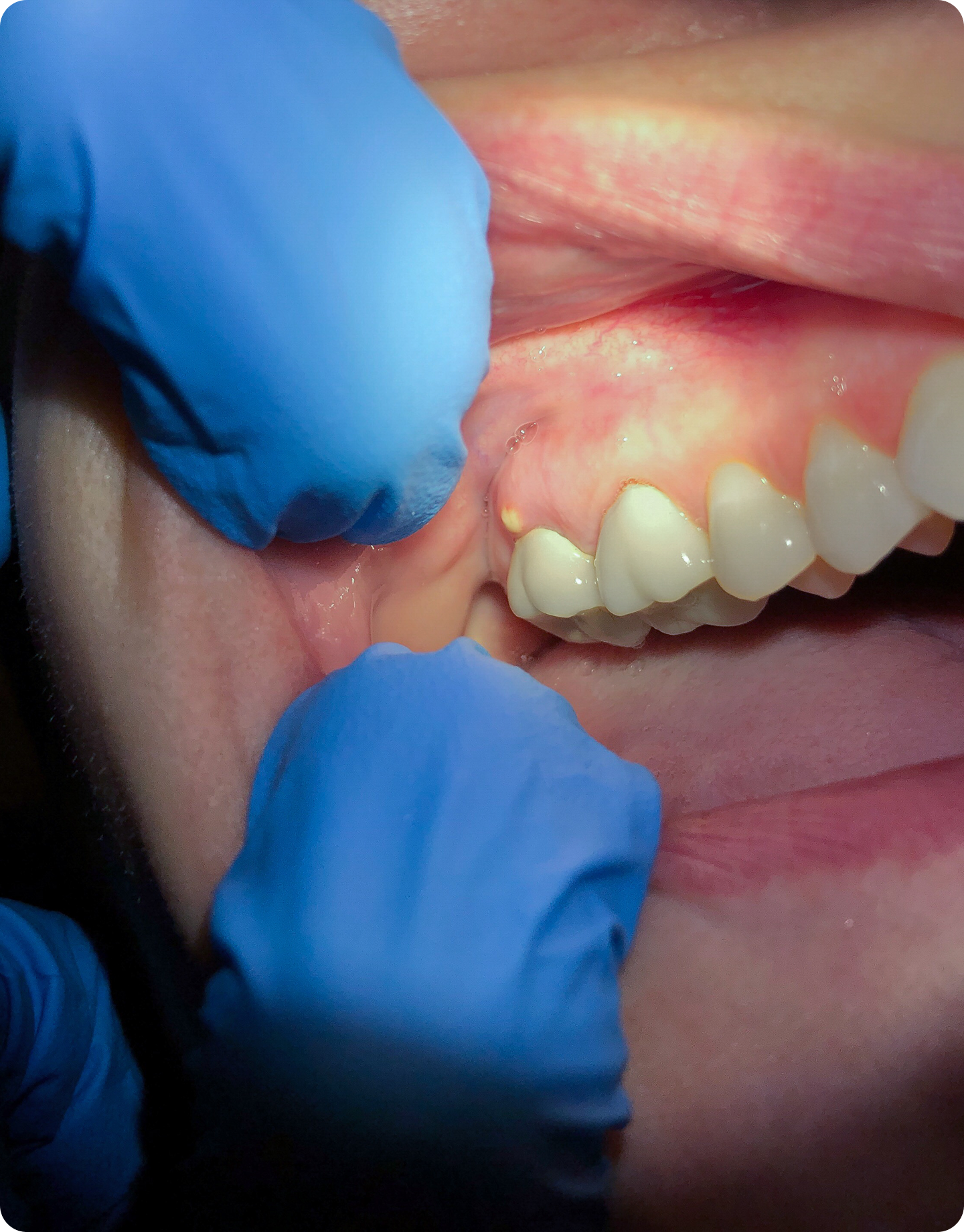 Dental abscess: Causes and treatment
