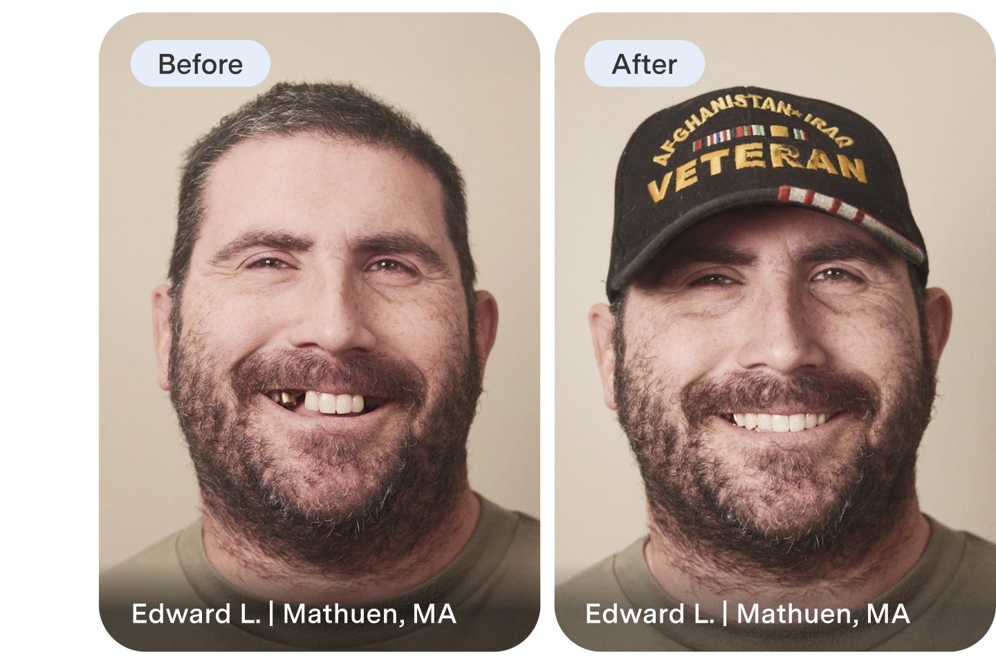 An Aspen Dental implant dentures patient highlights their before image and reveals their new smile after treatment.