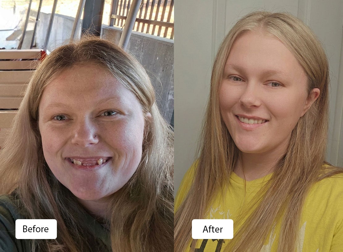 Before (left) and after (right) of a woman who received  partial upper and lower dentures