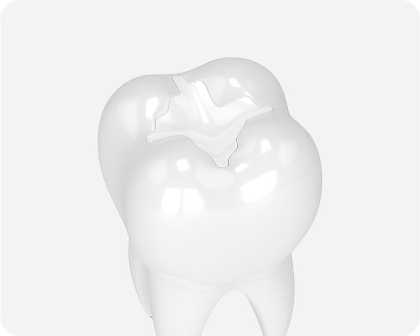 A 3D illustration of a white molar tooth showing a tooth-colored composite filling on the chewing surface.