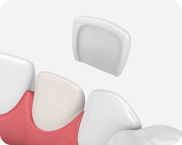 A 3D illustration of composite resin veneers being bonded to teeth, demonstrating a tooth-colored cosmetic restoration.