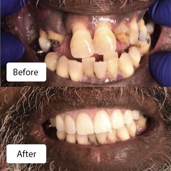 Before his Maxillary Arch extraction and immediate denture at Aspen Dental in Pembroke Pines, FL (top). After his Maxillary Arch extraction and immediate denture at Aspen Dental in Pembroke Pines, FL (bottom)