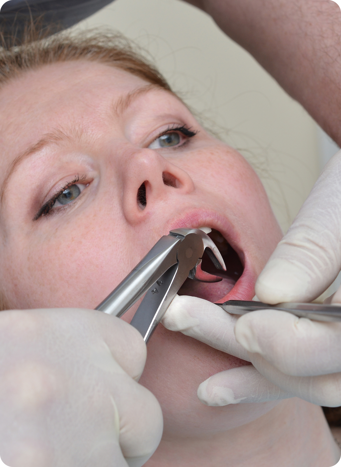 Emergency tooth extraction: when to pull a tooth and why it should be done by a dentist
