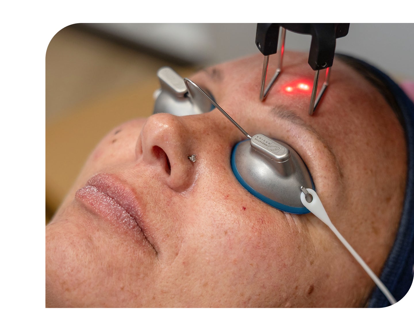 CoolPeel laser treatment targeting sunspots, acne, and skin texture