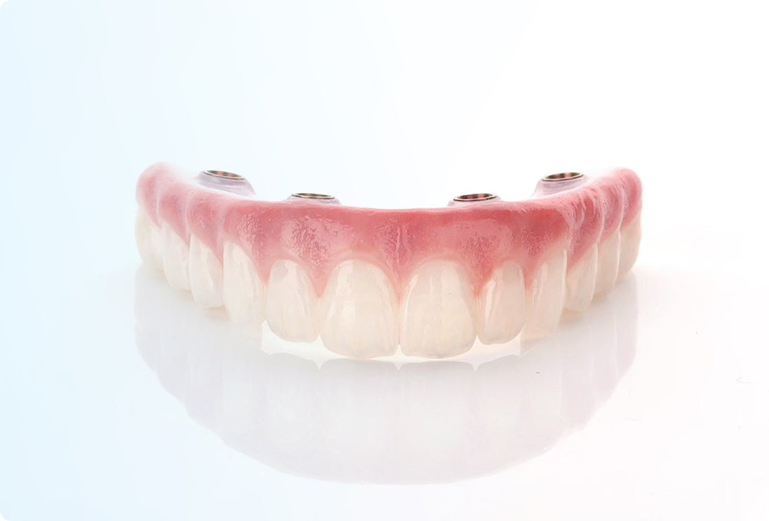 An upper arch dental implant model with four implants, designed to last a life-time with proper care and maintenance.