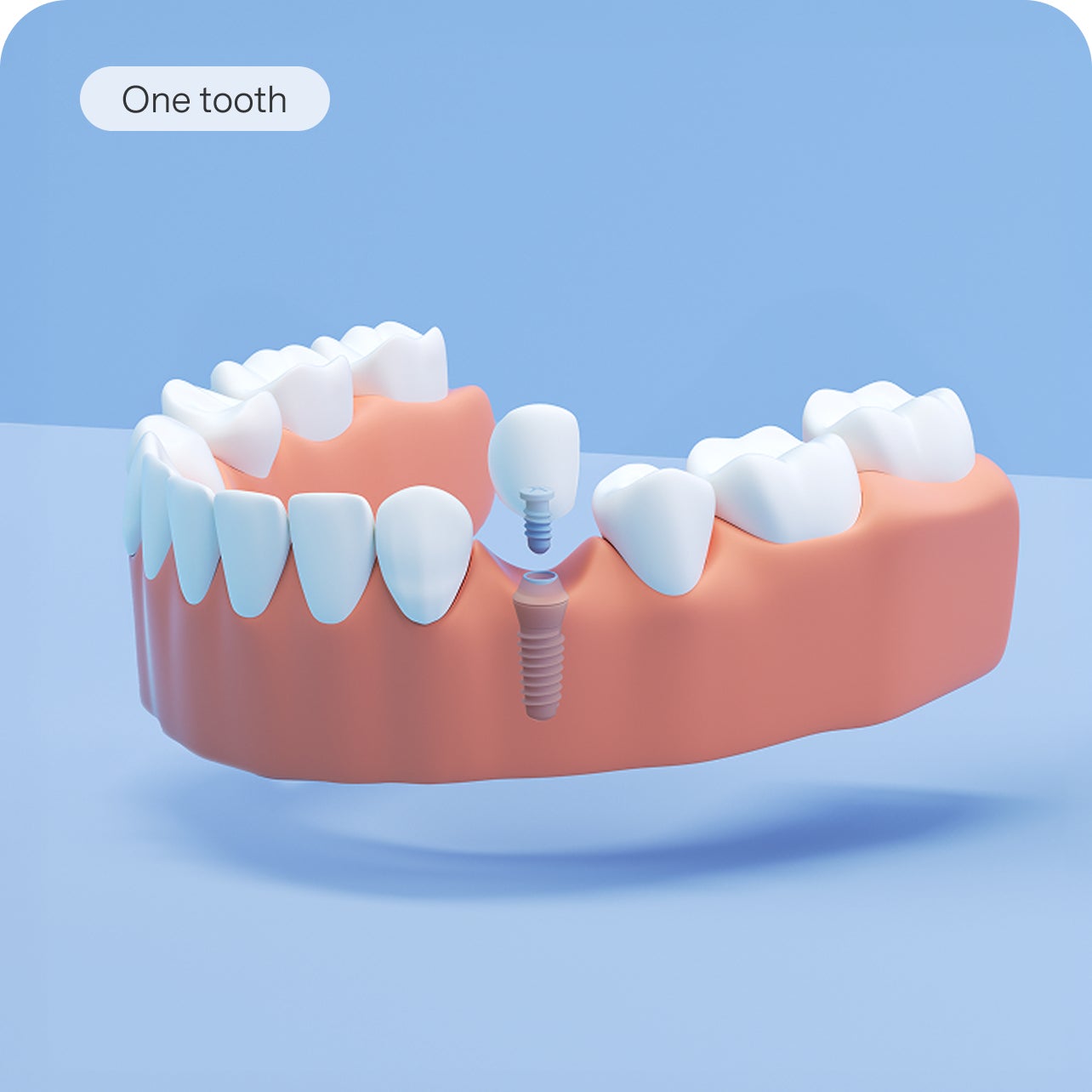 A 3D dental model of a lower jaw showing a multiple-tooth implant bridge. A text overlay reads "Multiple teeth".