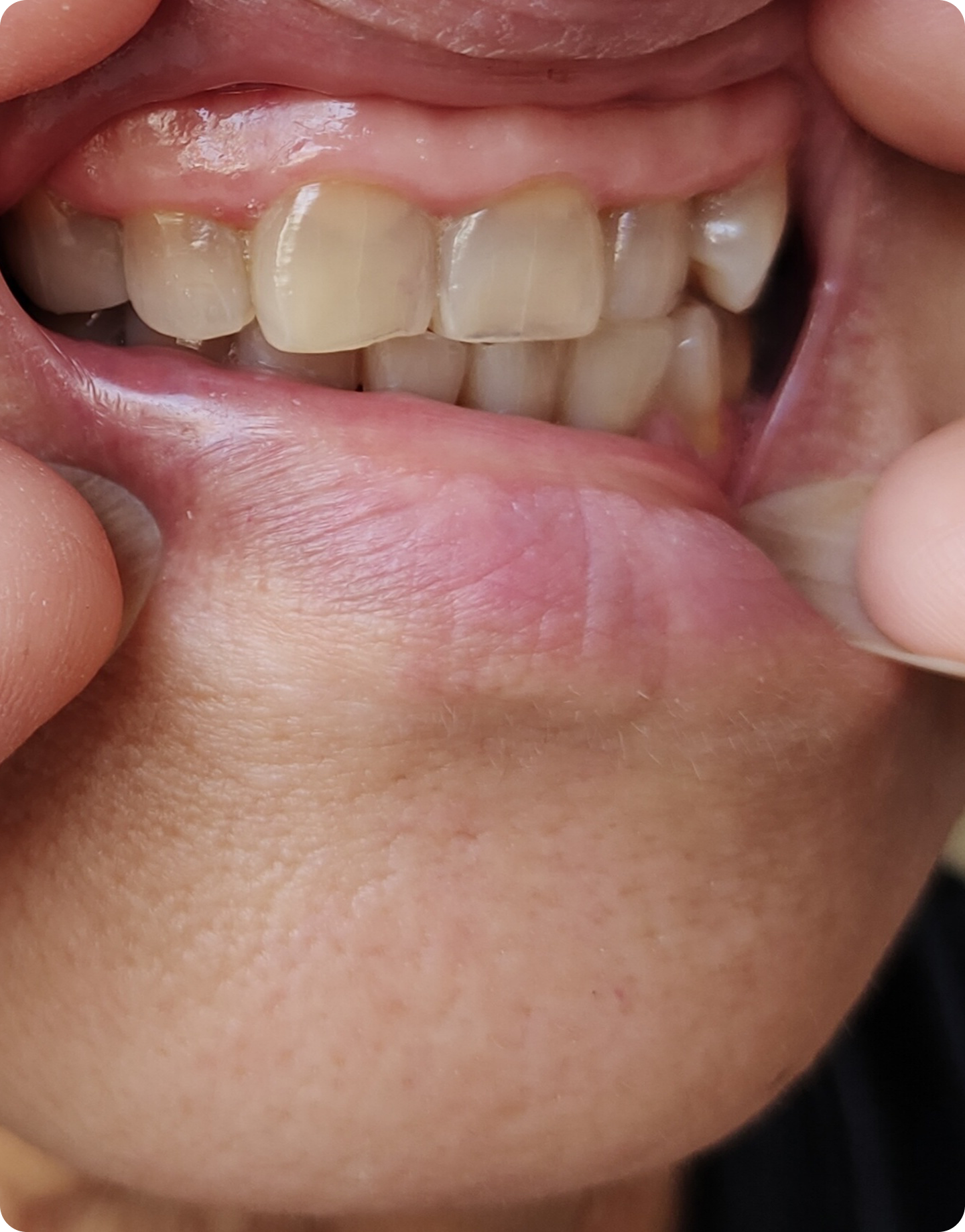 Close-up of a person pulling down their lower lip to show receding gums and exposed tooth roots near the gumline.