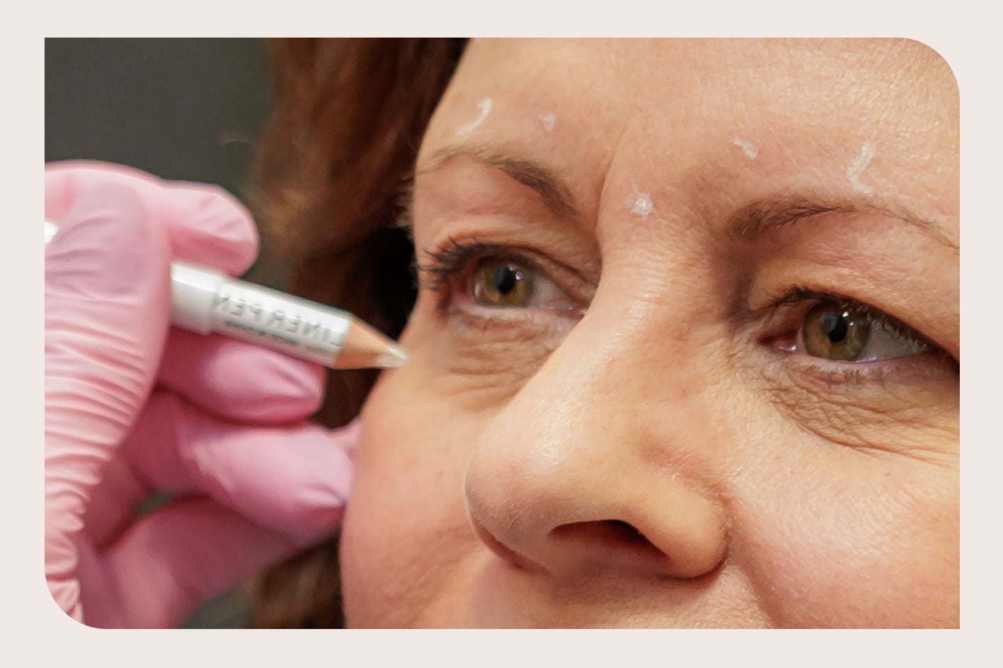 Facial mapping for cosmetic wrinkle treatment