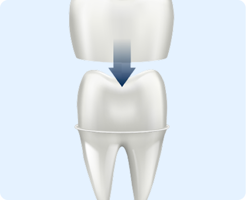 A dental crown is shown being placed onto a natural tooth. The crown is positioned above the tooth with a downward arrow indicating the placement.
