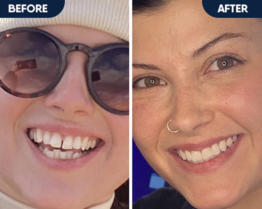 Before and after smile transformation showing results from clear aligner treatment with Motto