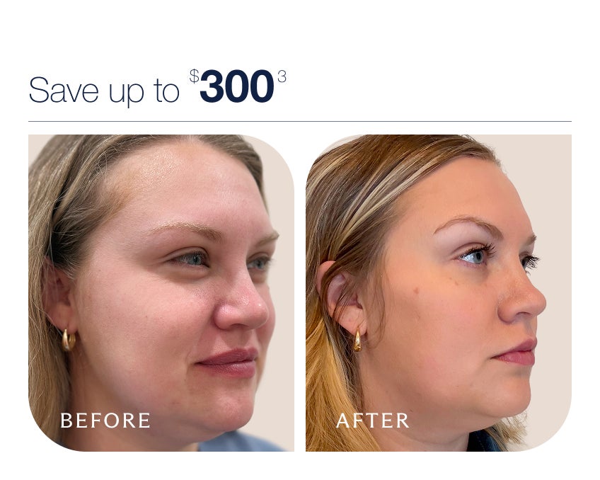Side by side before and after pictures of a woman after receiving filler at Chapter aesthetic studio below text that reads "Save up to $300"