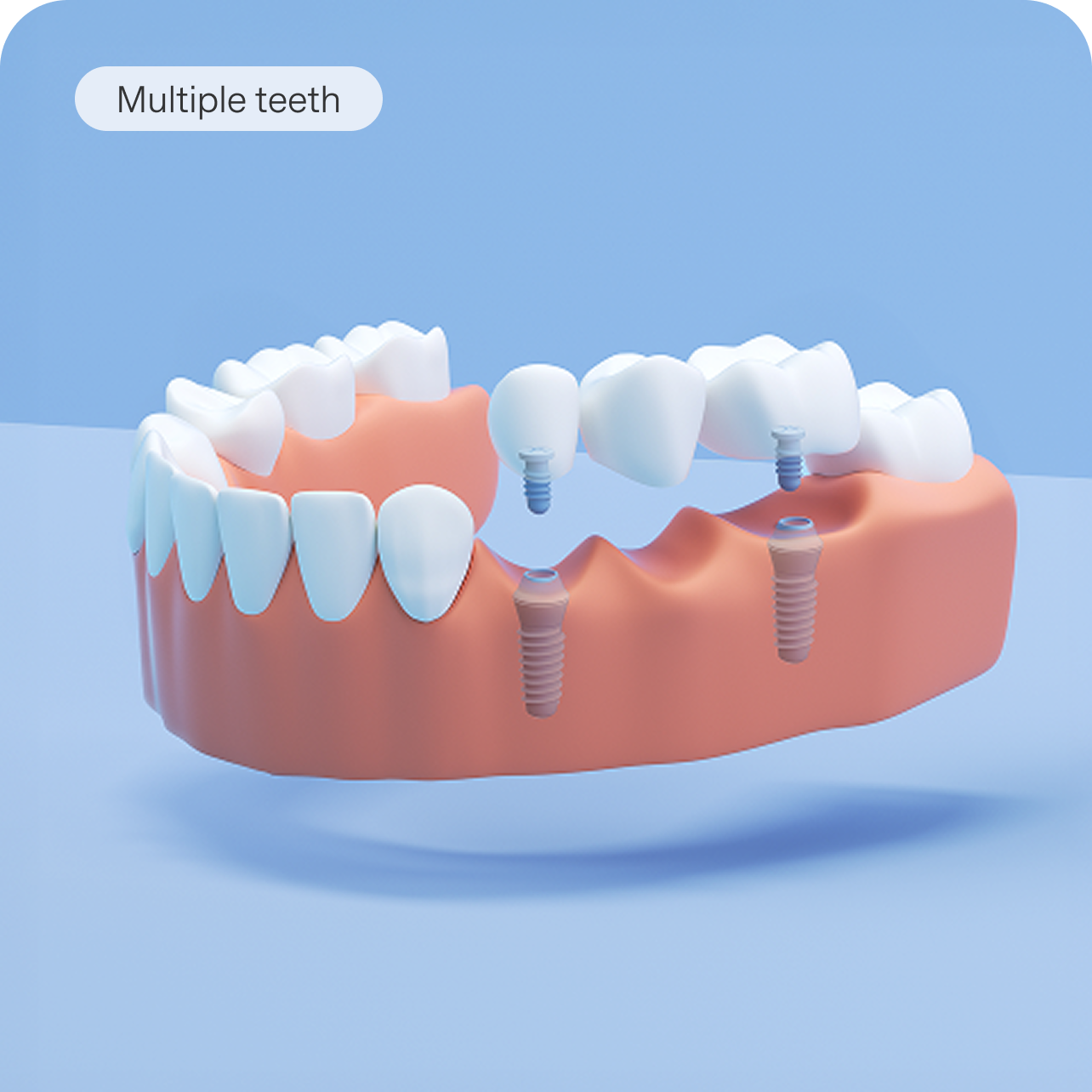 A 3D model of a lower jaw showing a multi-tooth implant bridge.