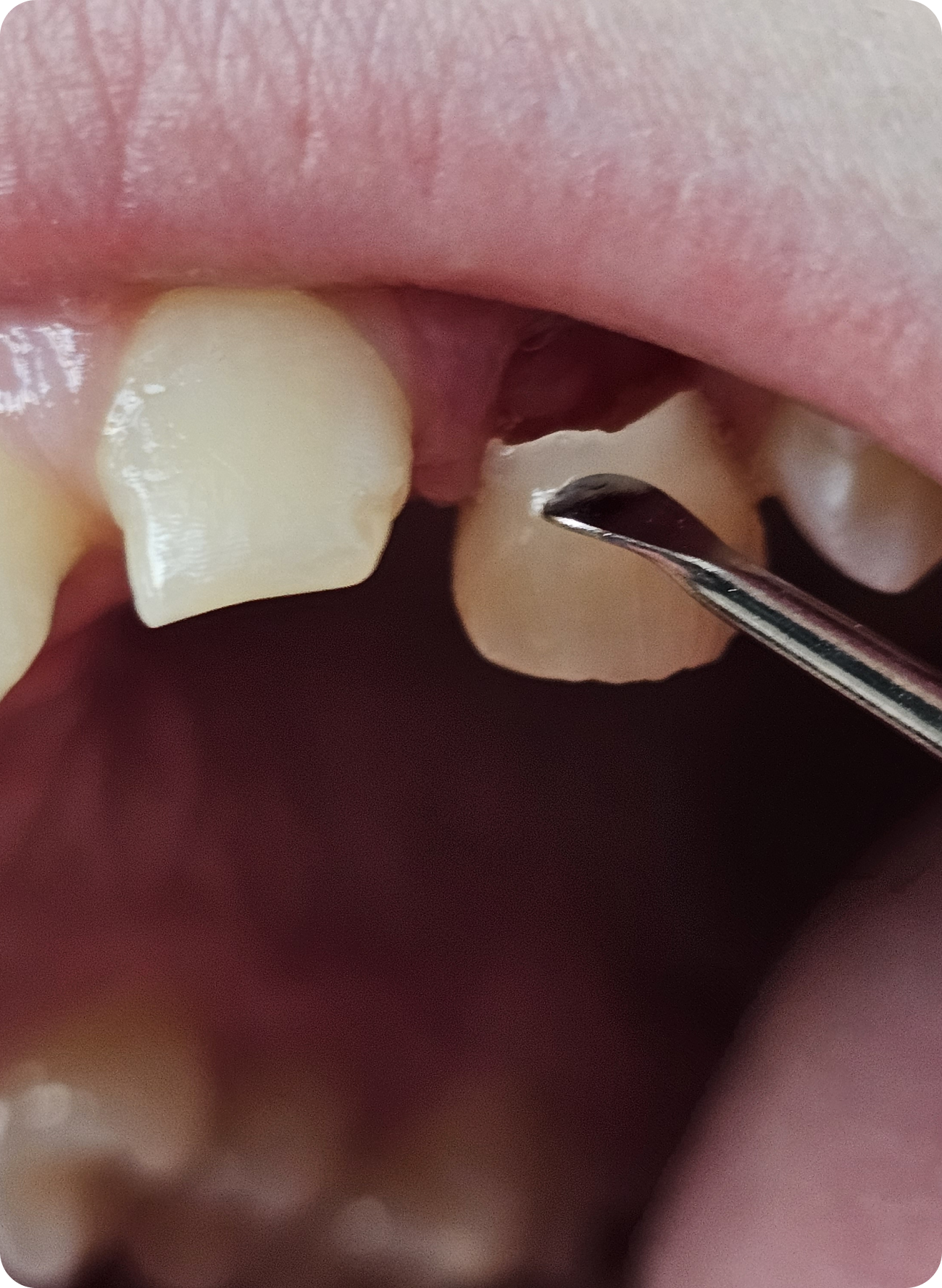 Is a chipped or broken tooth an emergency? When to see a dentist